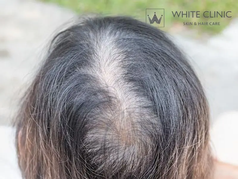 bị hói ở đỉnh đầu nữ