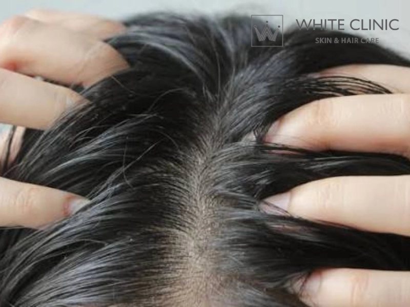 da đầu nhờn rụng tóc