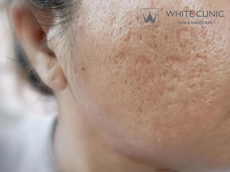 sẹo đáy nhọn và lỗ chân lông to