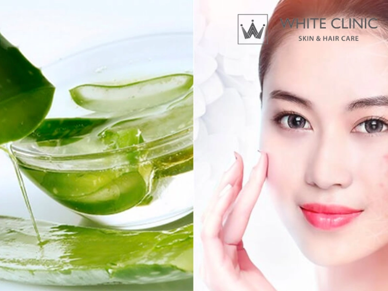làm mờ sẹo bằng nha đam làm mờ sẹo bằng nha đam