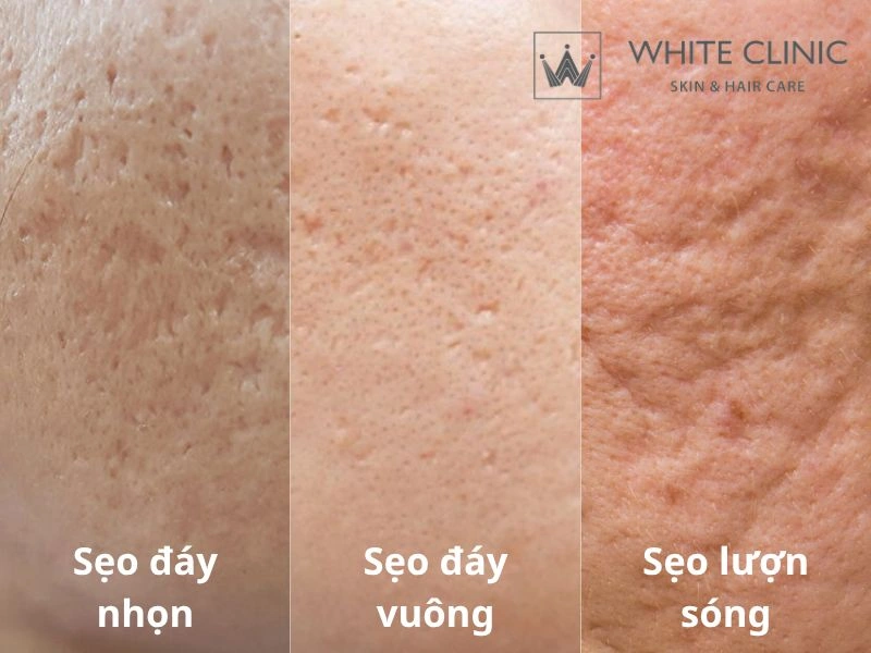 trị sẹo rỗ
