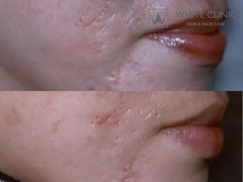 nghệ có giúp làm mờ sẹo không