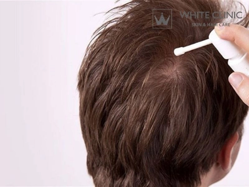 cách dùng minoxidil