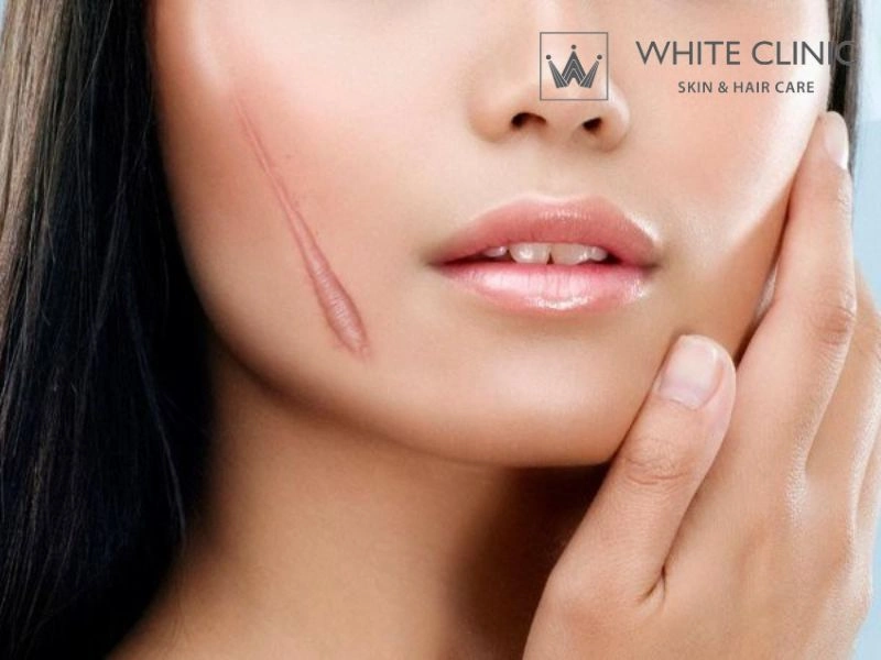 các loại sẹo mụn