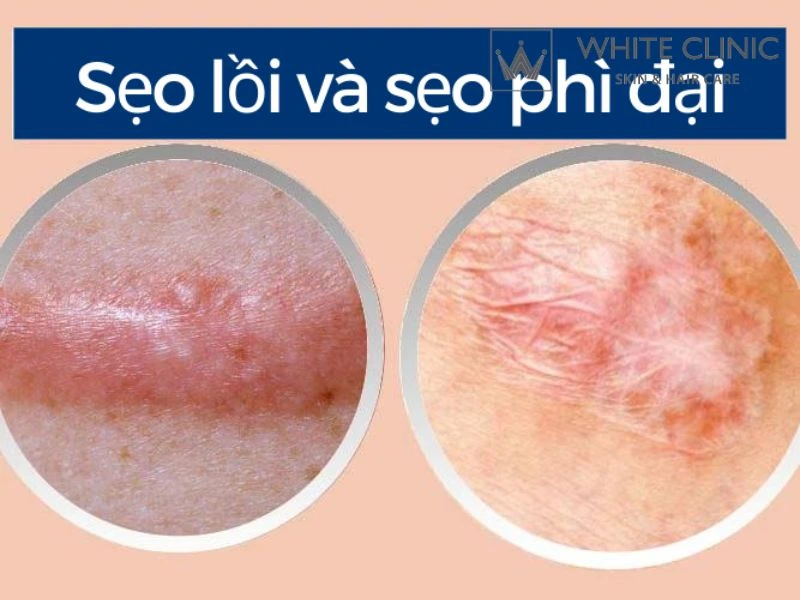 sẹo lồi