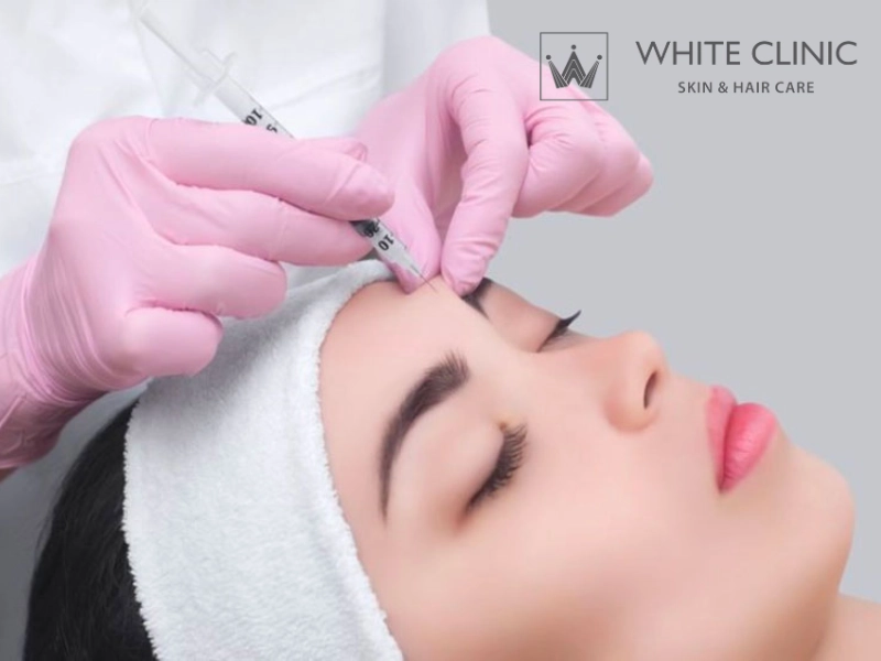 tiêm botox xoá nhăn trán