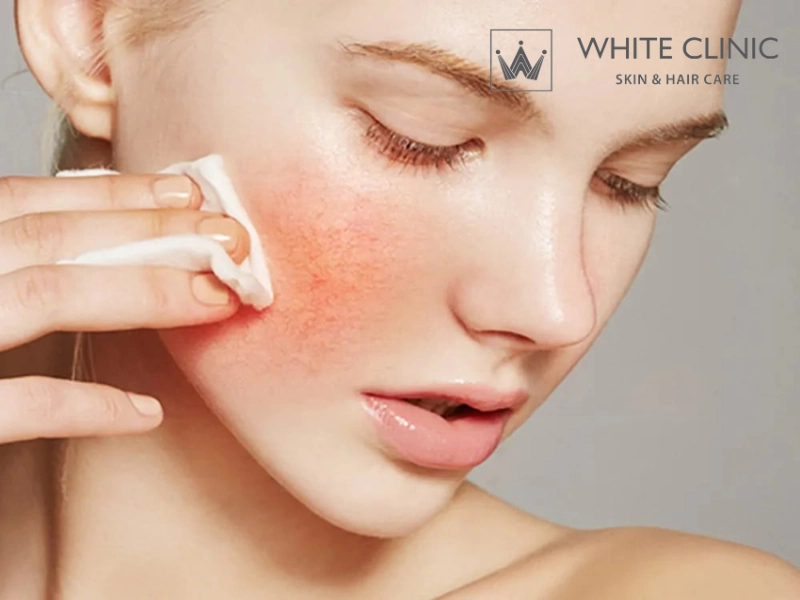 mụn cứ tái đi tái lại