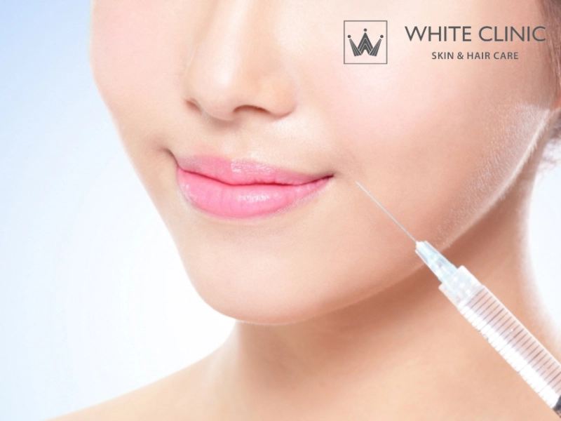 Tiêm Filler Rãnh Cười: Vì Sao Không Nên Chỉ “Lấp Đầy” Nếp Nhăn?