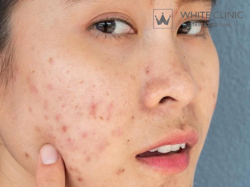 mặt nạ yến mạch trị thâm