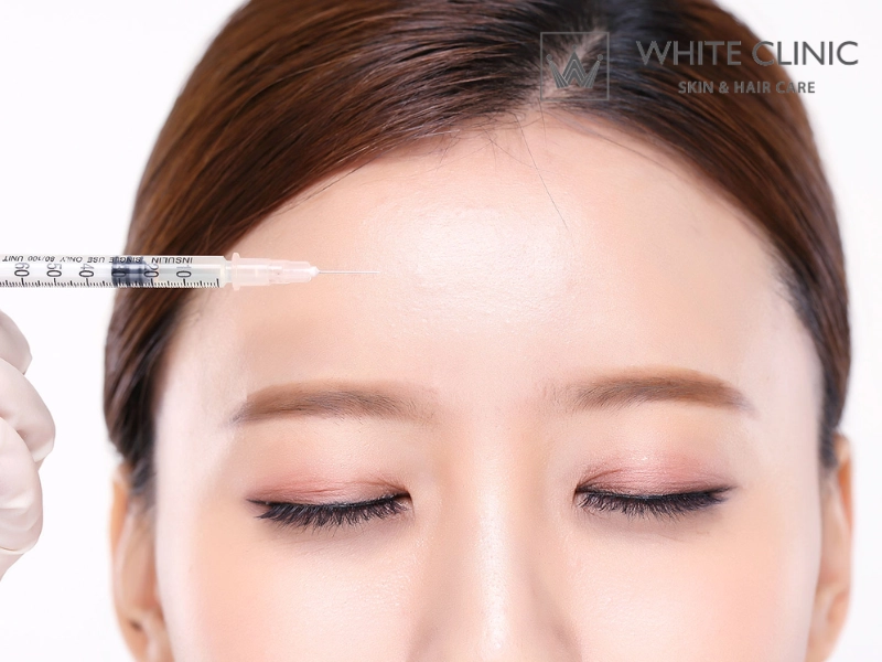 tiêm botox xoá nhăn trán