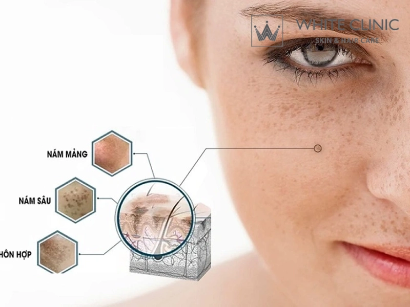 cách trị tàn nhang bằng cà chua
