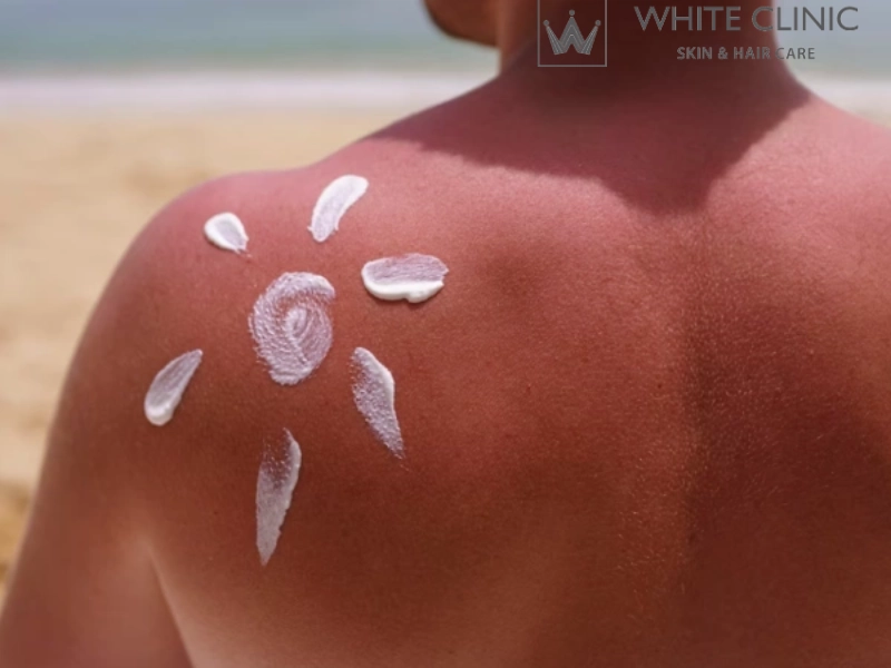 Phục Hồi Da Mặt Bị Cháy Nắng: Giải Pháp Tái Tạo Cấp Tốc Từ White Clinic