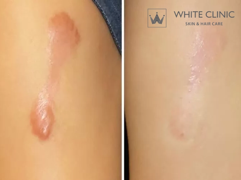 Sẹo mổ lồi có hết 100% không và mất bao lâu?