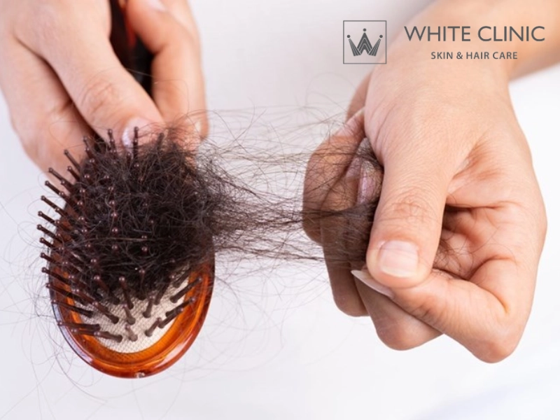 rụng tóc lan tỏa rụng tóc lan tỏa