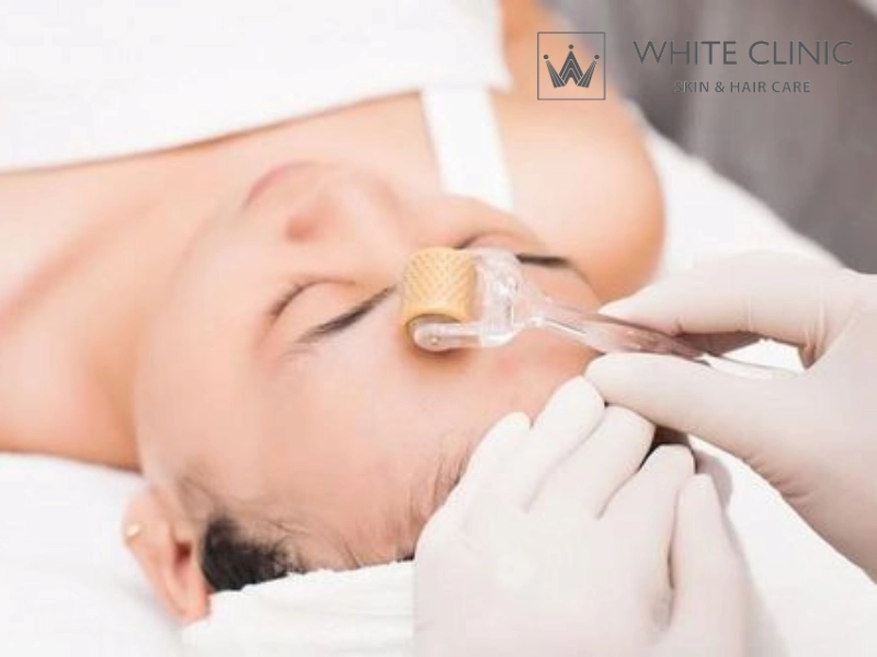 giá lăn kim trị sẹo rỗ giá lăn kim trị sẹo rỗ
