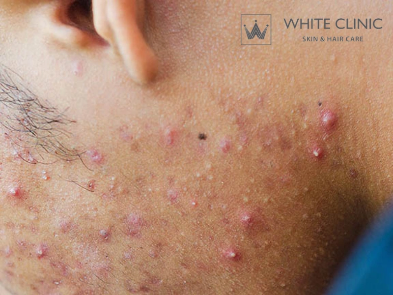 các vùng bị mụn trên mặt