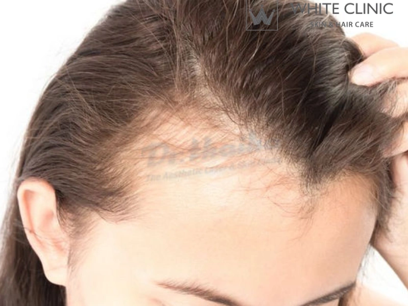 rụng tóc sau sinh