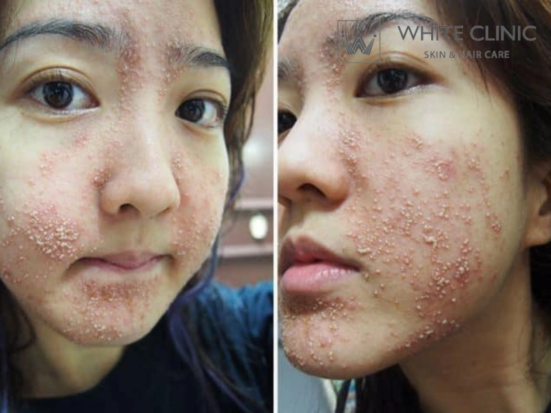 tác hại của kem trộn tác hại của kem trộn