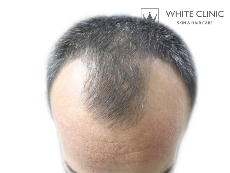 Rụng tóc do androgen