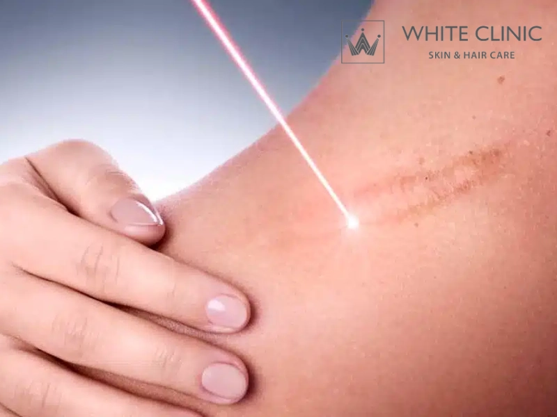 Bắn Laser Sẹo Lồi, Tái Tạo Làn Da Với Công Nghệ Cao Tại White Clinic 