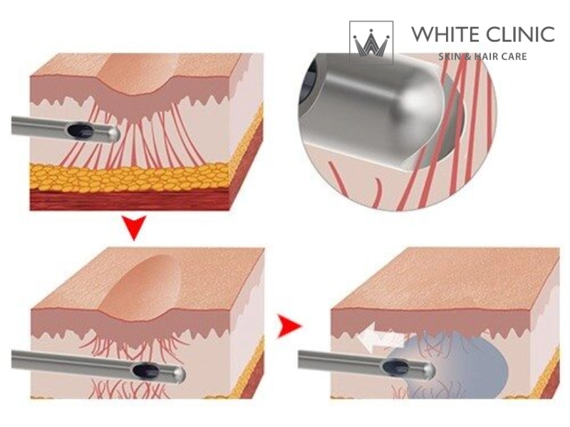 cắt đáy sẹo cắt đáy sẹo