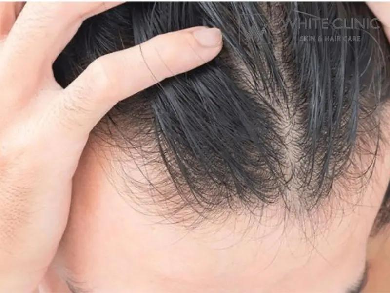 tóc mỏng tóc mỏng