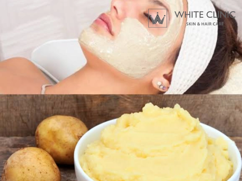 mặt nạ khoai tây trị mụn thâm mặt nạ khoai tây trị mụn thâm