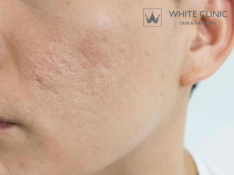 sẹo đáy nhọn và lỗ chân lông to