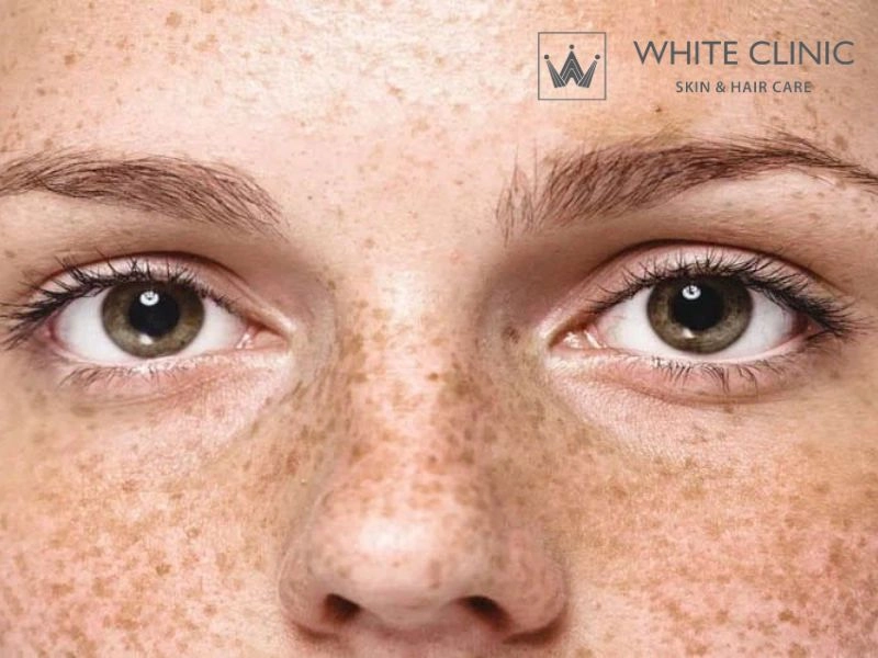 Phân biệt Nám và Tăng sắc tố sau viêm (PIH): Cách nhận diện để điều trị đúng hướng