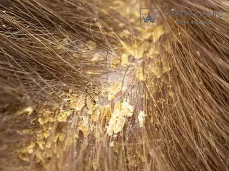 phân biệt gàu và nấm da đầu phân biệt gàu và nấm da đầu