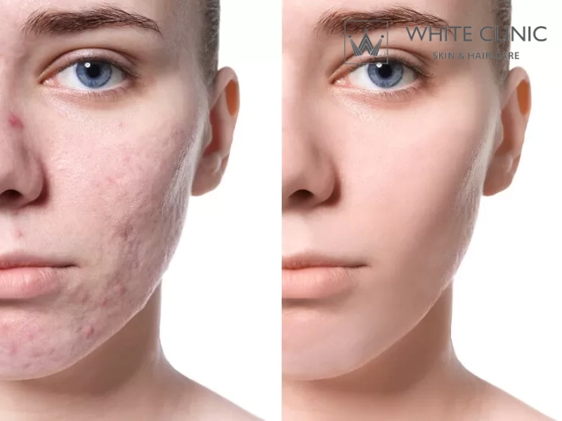 so sánh laser CO2 và Er:YAG