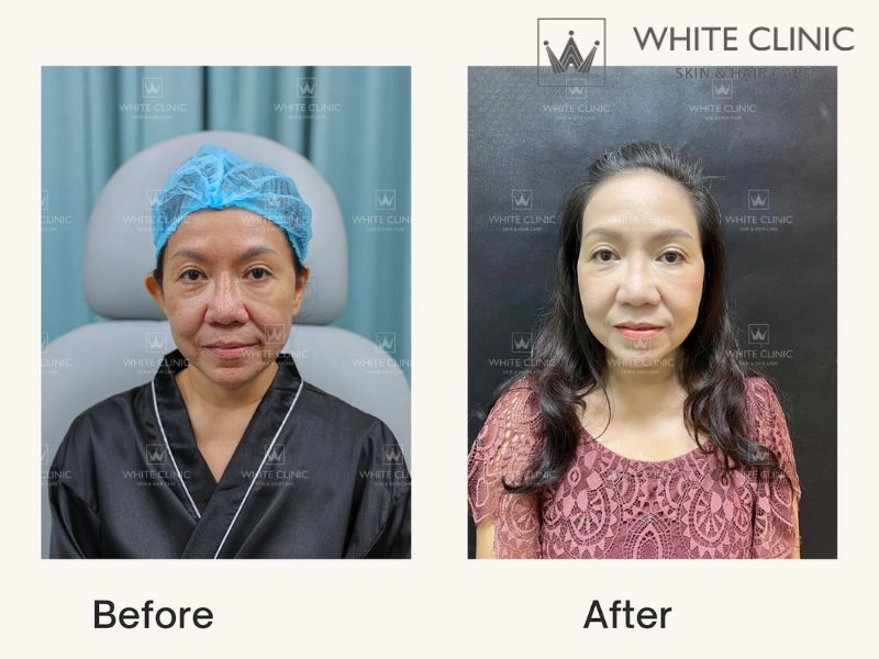 Lựa chọn White Clinic cho liệu trình BIO LIFT 20 với Revok50 Lựa chọn White Clinic cho liệu trình BIO LIFT 20 với Revok50