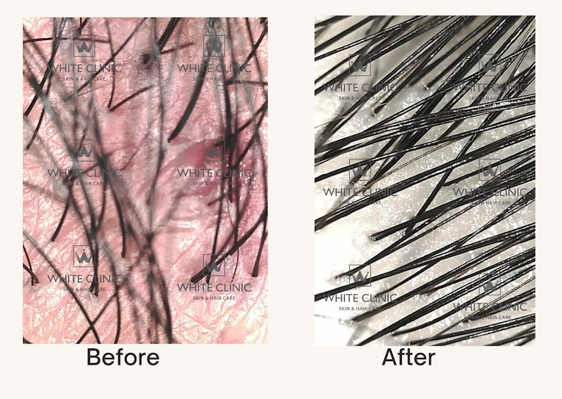 Hình ảnh trước và sau khi thực hiện liệu trình SCALP DETOX
