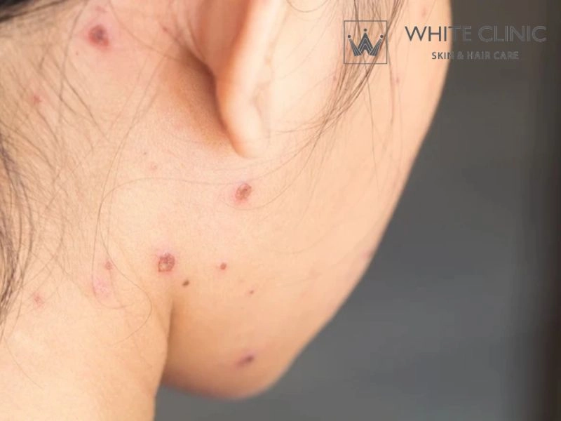 So sánh các kỹ thuật trị sẹo thủy đậu: Khi nào dùng phương pháp nào? So sánh các kỹ thuật trị sẹo thủy đậu: Khi nào dùng phương pháp nào?