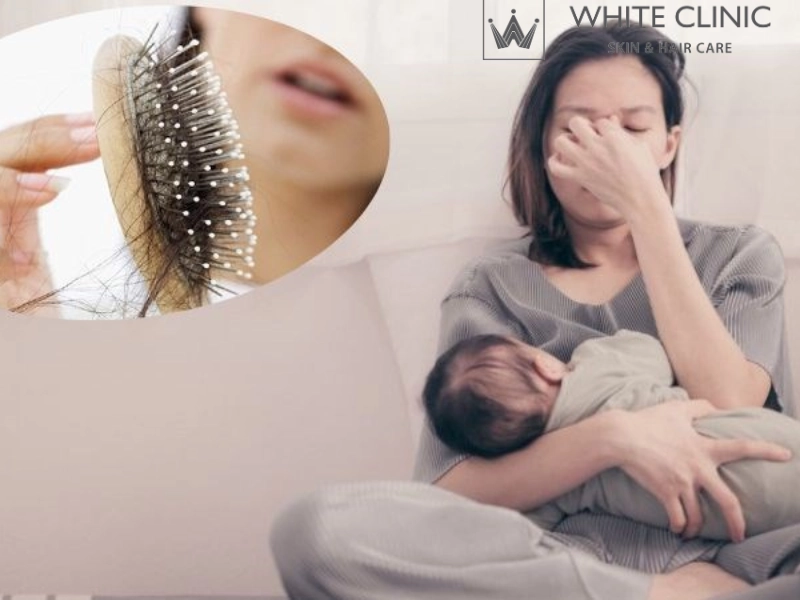Nguyên Nhân Rụng Tóc Sau Sinh Và Giải Pháp Tái Sinh Tóc Tại White Clinic
