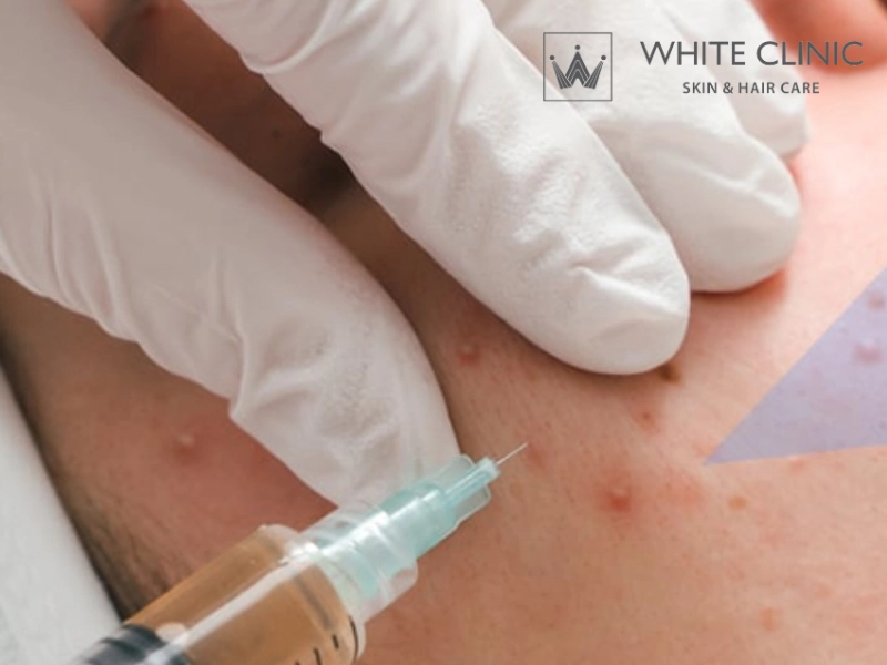 da mụn có tiêm meso được không