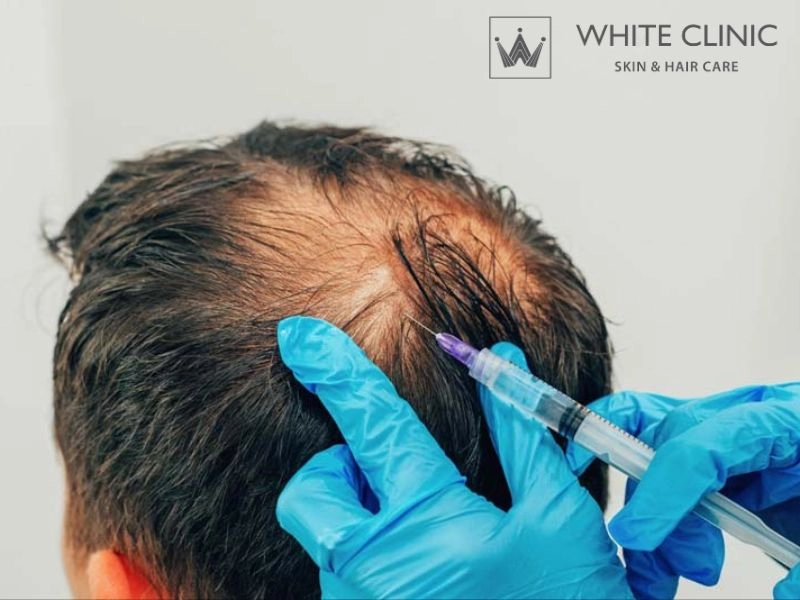 Các phương pháp điều trị rụng tóc tự miễn phổ biến hiện nay