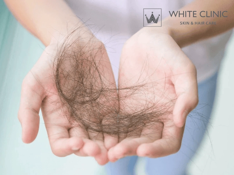 Chữa Rụng Tóc Nội Tiết: Tìm Hiểu Nguyên Nhân Và Giải Pháp Điều Trị 