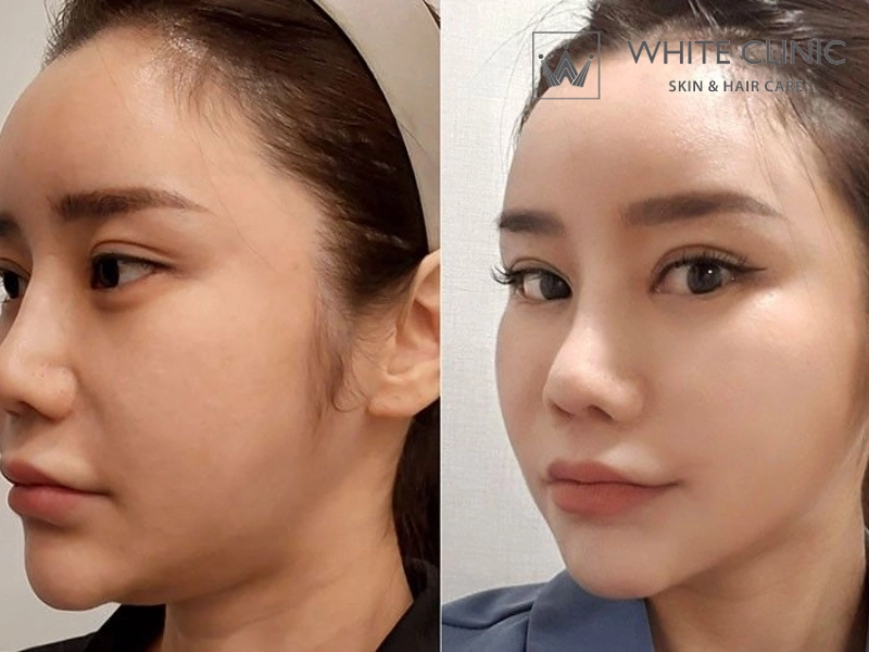 Chọn dịch vụ Microtox tại White Clinic