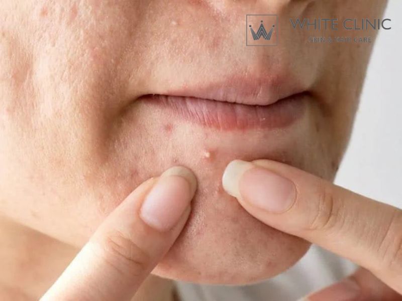 Mụn Đầu Trắng: Nguyên Nhân Hình Thành Và Cách Điều Trị 