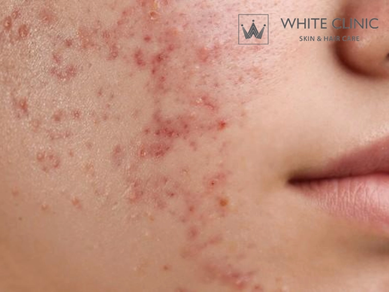 cách làm mặt nạ diếp cá trị thâm