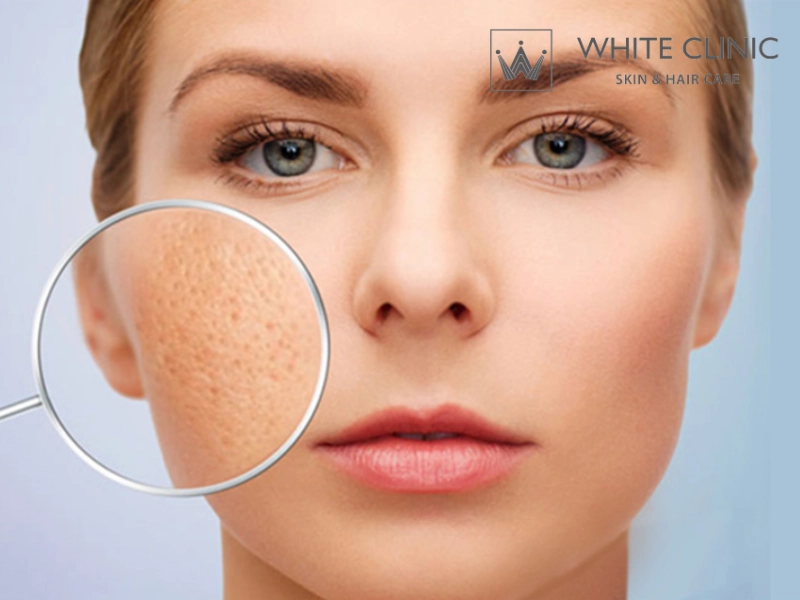 cách trị sẹo đáy nhọn cách trị sẹo đáy nhọn