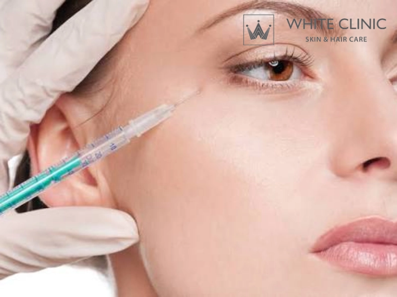tiêm botox xoá nhăn mắt tiêm botox xoá nhăn mắt