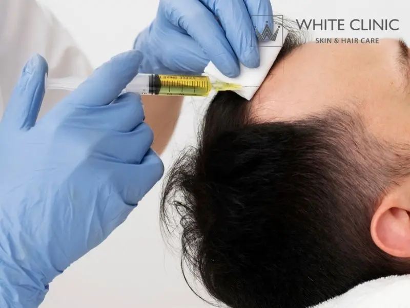 Tiêm PRP điều trị rụng tóc có hiệu quả không và kỳ vọng thực tế? 