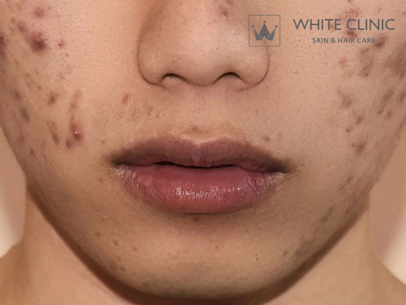 Thâm Mụn Có Tự Hết Không Và Thời Gian Phục Hồi Thực Tế Cho Từng Loại Thâm