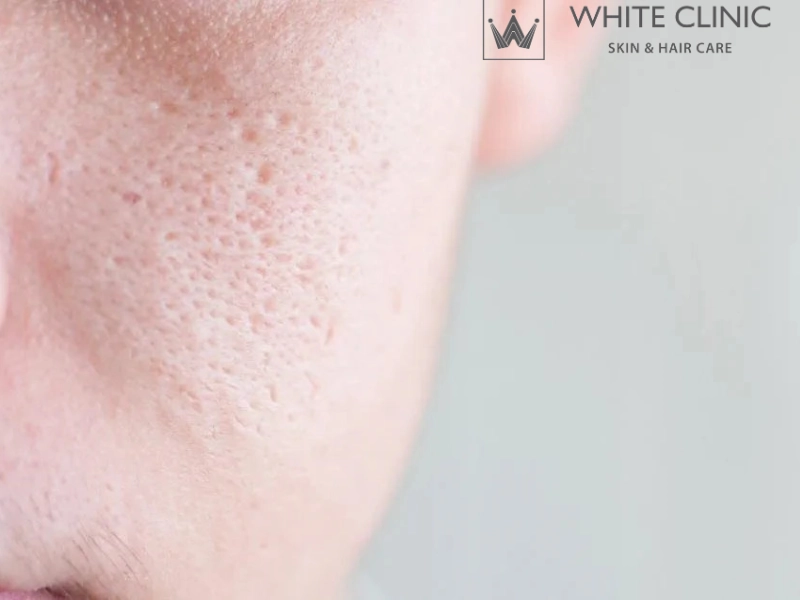 laser thu nhỏ lỗ chân lông laser thu nhỏ lỗ chân lông