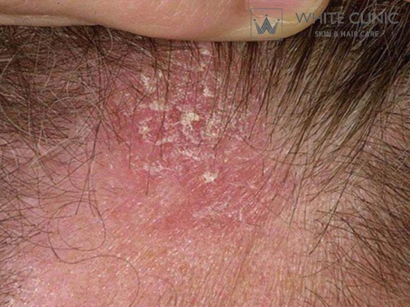 Viêm Da Dầu (Tiết Bã) Ở Đầu: Nguyên Nhân Gây Rụng Tóc & Cách Trị Dứt Điểm