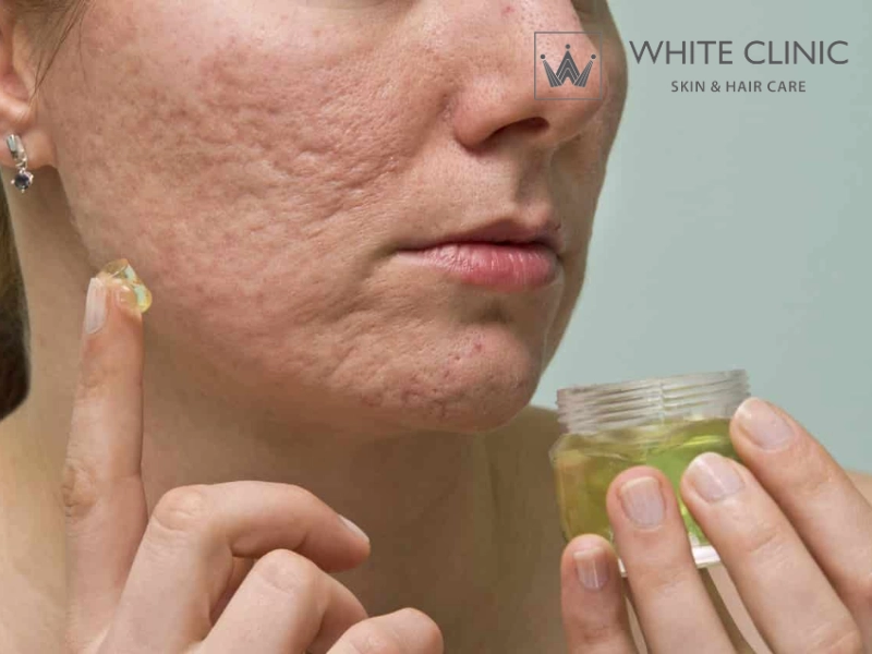 làm mờ sẹo bằng nha đam làm mờ sẹo bằng nha đam