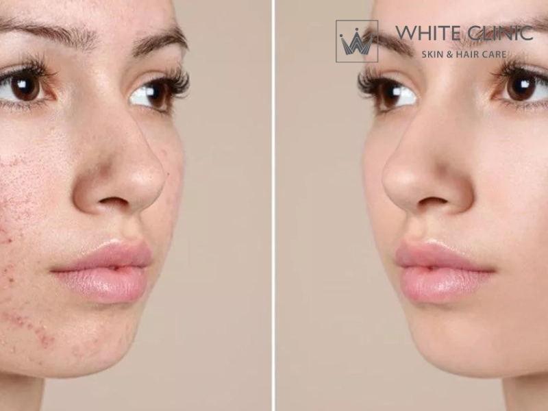 nổi mụn ở trán