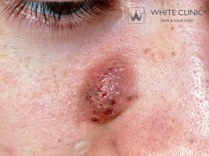 Mụn Nang Là Gì? Nguyên Nhân, Dấu Hiệu Và Cách Điều Trị An Toàn 